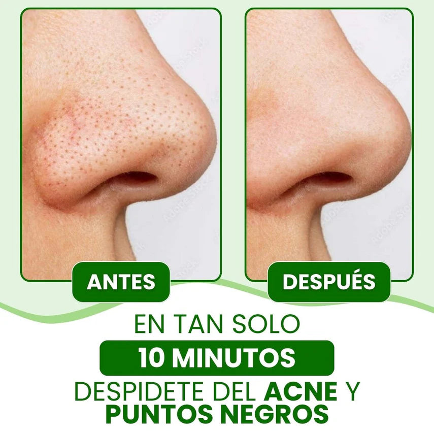 Lanbena™ Mascarilla Avanzada para Puntos Negros